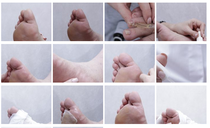 Этапы педикюра для больных даибетом